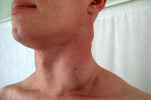 Лимфогранулематоз