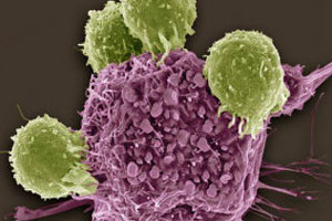 ретикулосаркома