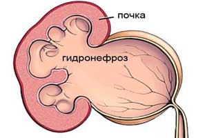 гидронефроз почки