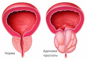 аденома простаты