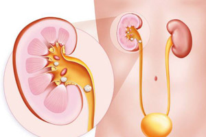 мочекаменная болезнь