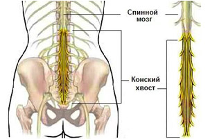 синдром конского хвоста