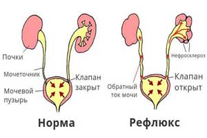 Пузырно-мочеточниковый рефлюкс - что это такое, причины, симптомы, диагностика, лечение