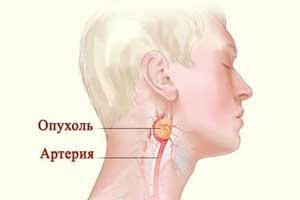 хемодектома