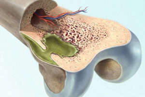 Лечение остеомиелита в Израиле 