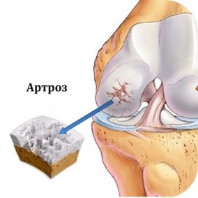 Артроз
