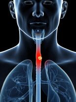 лечение рака пищевода