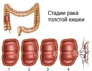 Лечение рака прямой кишки