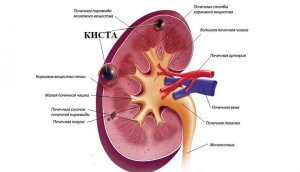 парапельвикальные кисты обеих почек прогноз жизни. Смотреть фото парапельвикальные кисты обеих почек прогноз жизни. Смотреть картинку парапельвикальные кисты обеих почек прогноз жизни. Картинка про парапельвикальные кисты обеих почек прогноз жизни. Фото парапельвикальные кисты обеих почек прогноз жизни