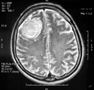 Менингиома