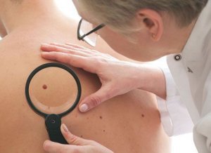 Признаки рака кожи