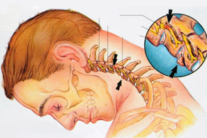 шейный остеохондроз