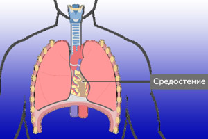 рак средостения