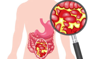 Лечение перитонита в Израиле