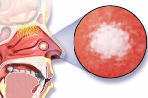 Лечение рака носа в Израиле 