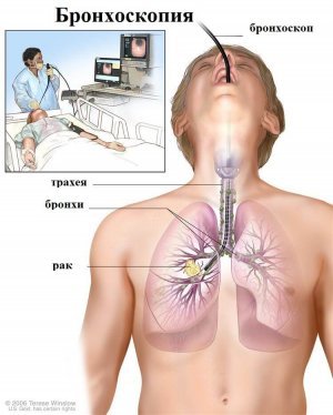 Симптомы рака бронхов