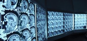 Нейрохирургия в Израиле