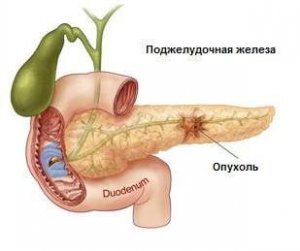 лечение рака поджелудочной