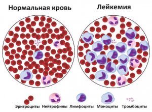 Лечение рака крови в Израиле