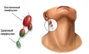 лечение рака лимфоузлов