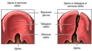 Что такое болезнь волчья пасть. Смотреть фото Что такое болезнь волчья пасть. Смотреть картинку Что такое болезнь волчья пасть. Картинка про Что такое болезнь волчья пасть. Фото Что такое болезнь волчья пасть