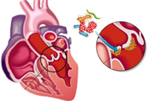 эндокардит