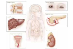 нейробластома