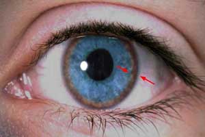 болезнь Вильсона