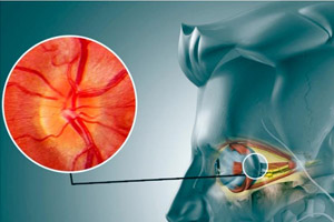 ганглионеврит