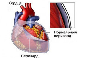 мезотелиома перикарда