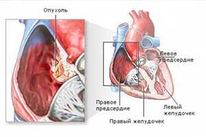 фиброма сердца