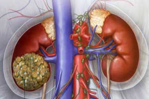 почечно-клеточный рак