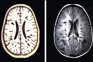 мукополисахаридоз