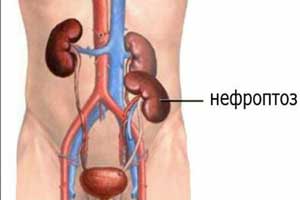 Нефроптоз — причины опущения почек, симптомы, диагностика и лечение в Москве.