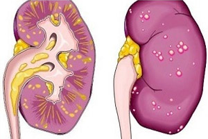 паранефрит