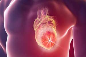 опухоли сердца