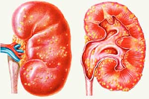 наследственный нефрит