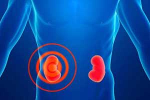 мегакаликоз