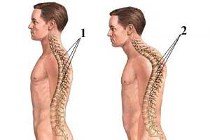 болезнь Шейермана-Мау