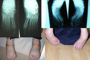 болезнь Фридрейха