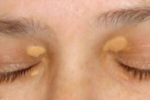 Лечение ксантелазмы в Израиле