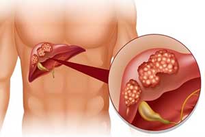 гепатобластома