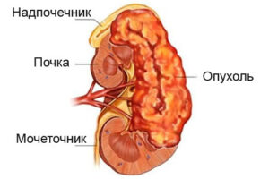 альдостерома