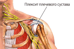 плечевой плексит