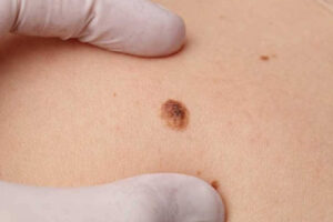 Лечение меланоза Дюбрейля в Израиле