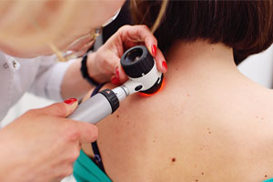 синдром Сезари