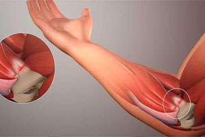 эпикондилит