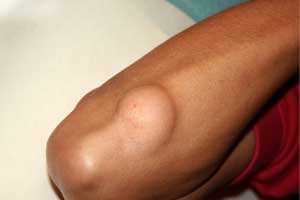 липосаркома