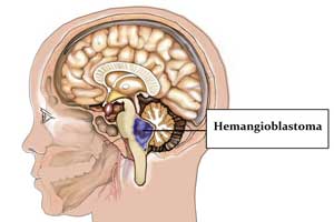 Гемангиобластома