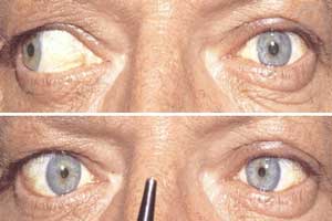 офтальмоплегия